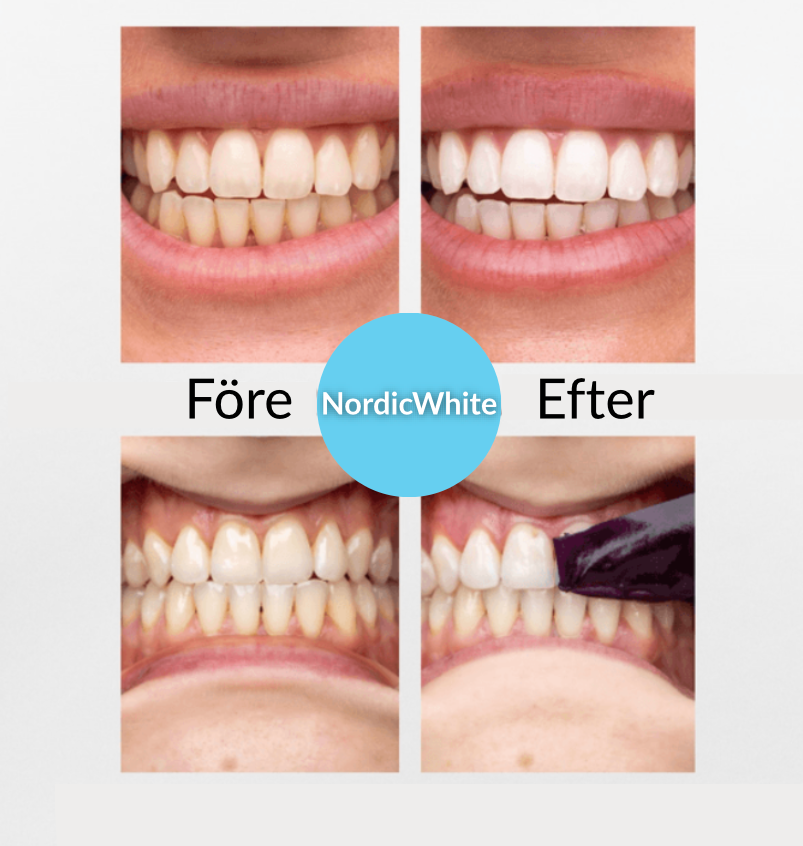 Blekningsremsor – Ett Självsäkert Leende