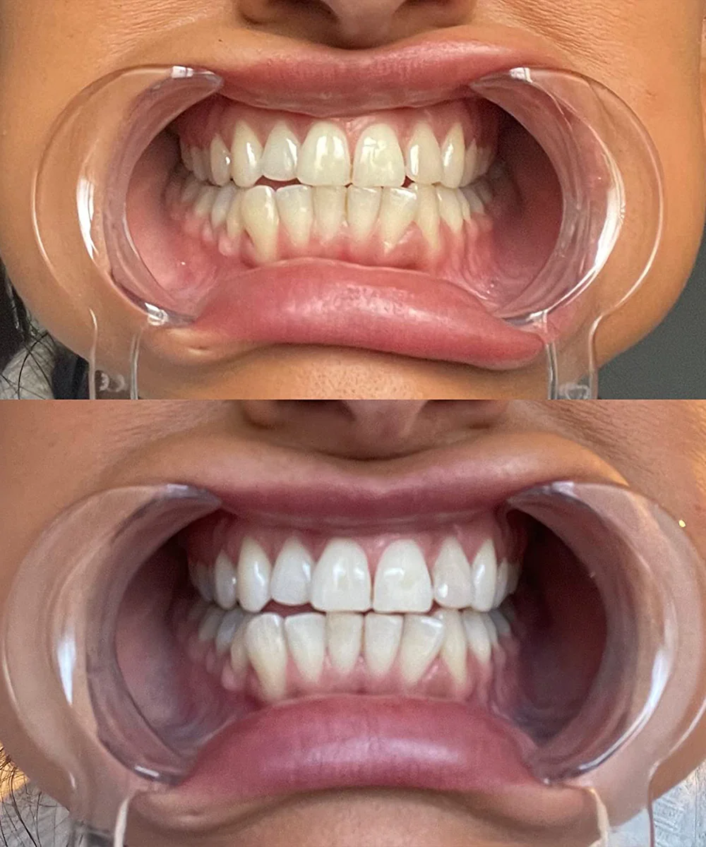 Blekningsremsor – Ett Självsäkert Leende